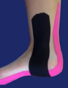 How Kinesiology Tape Works